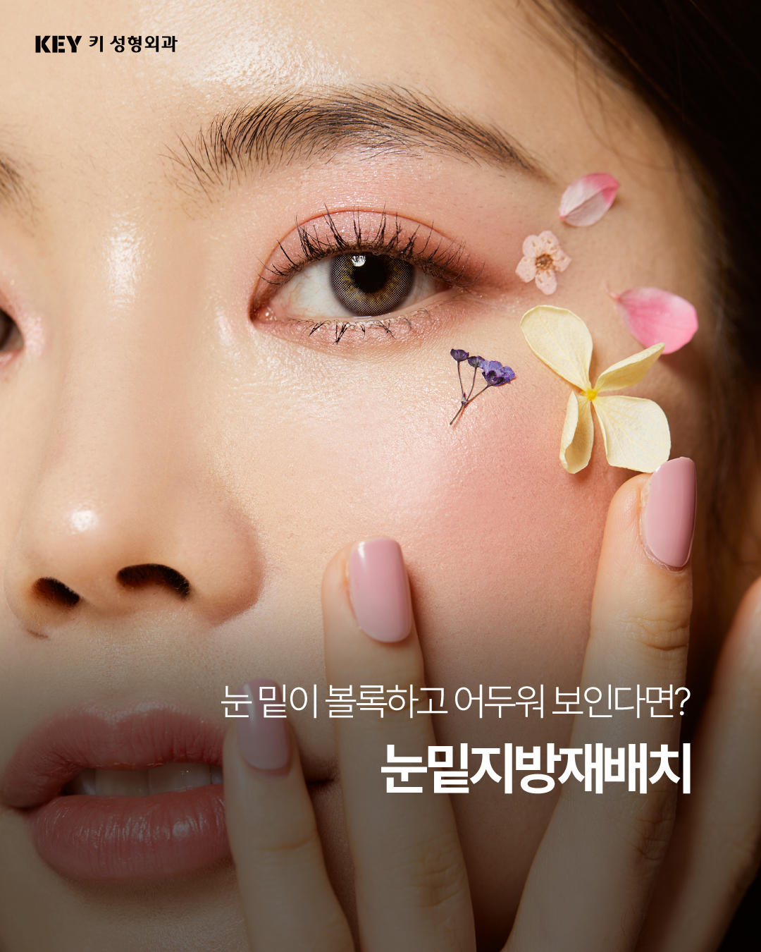 눈밑지방재배치
