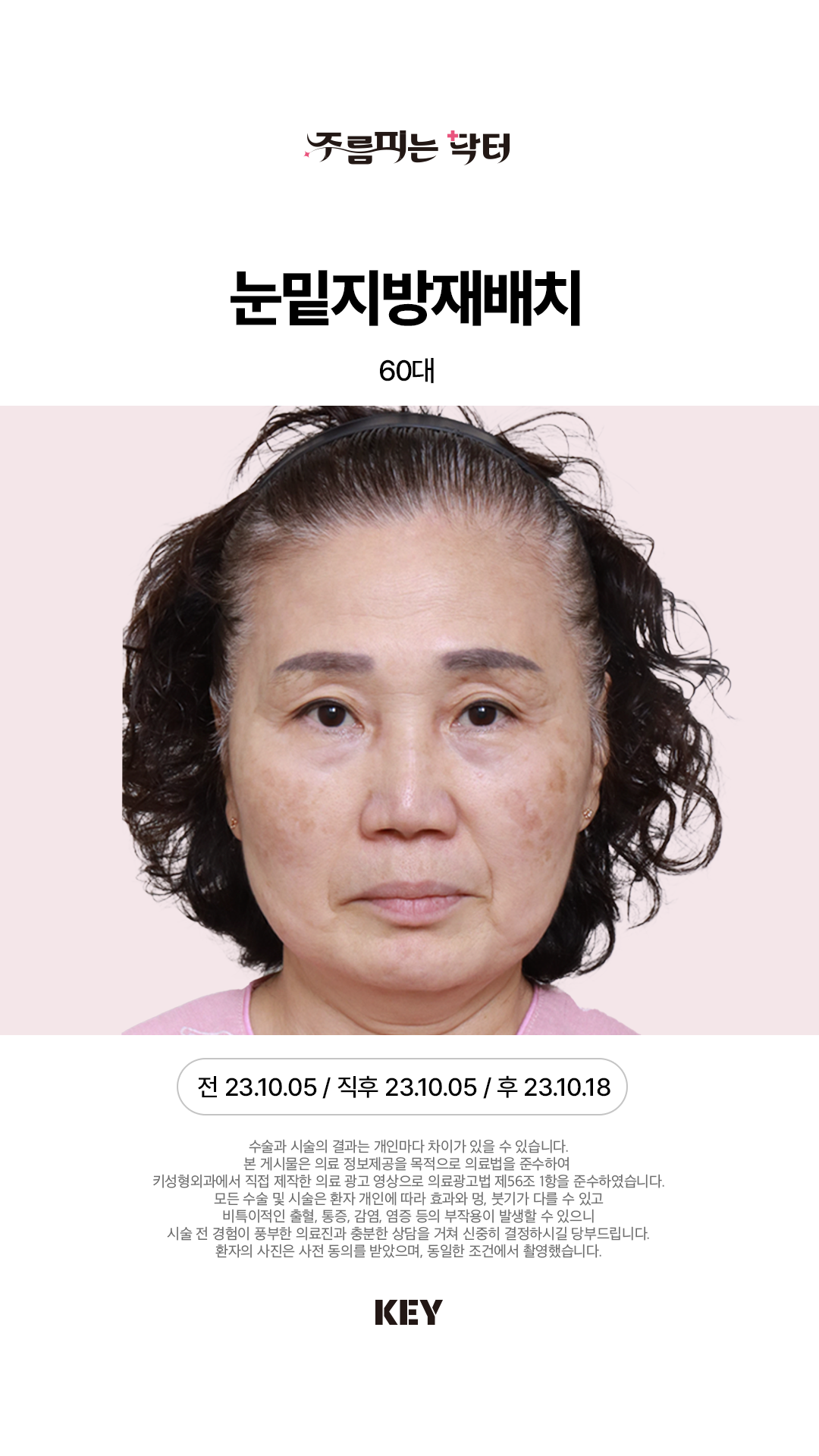 눈밑지방재배치 Before 1