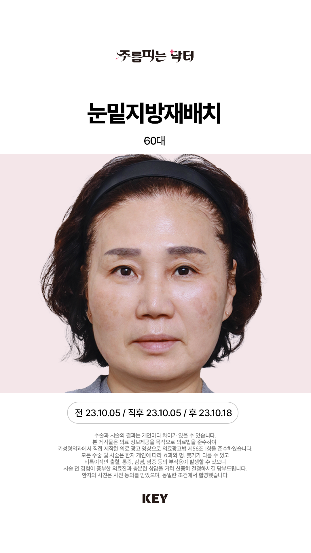 눈밑지방재배치 After 1