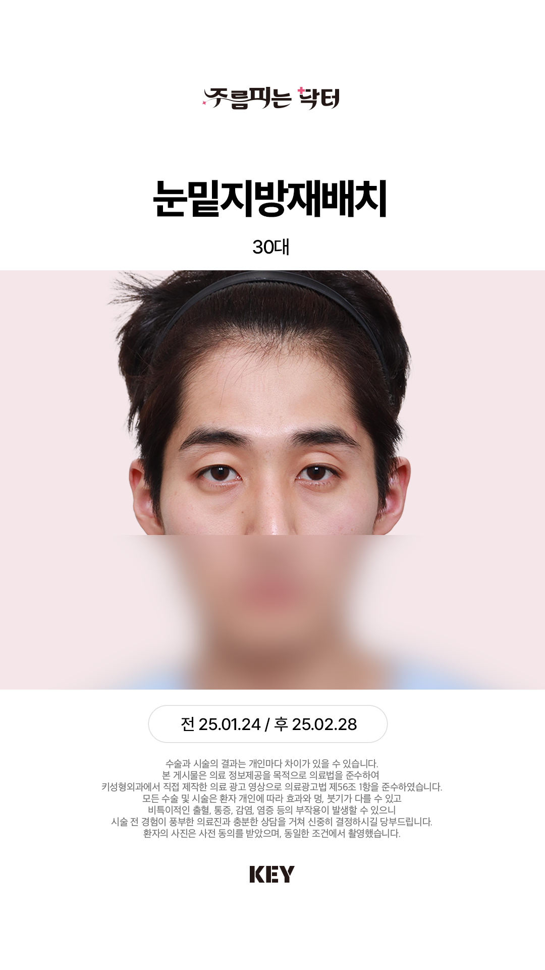 눈밑지방재배치 Before 2