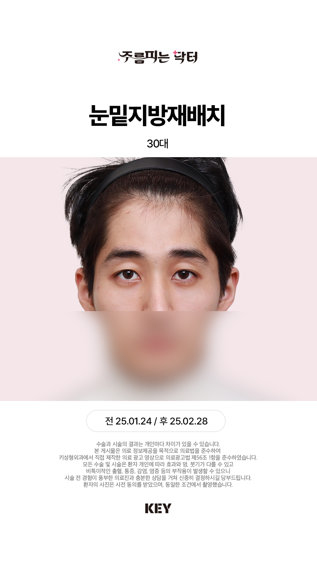 눈밑지방재배치 After 2