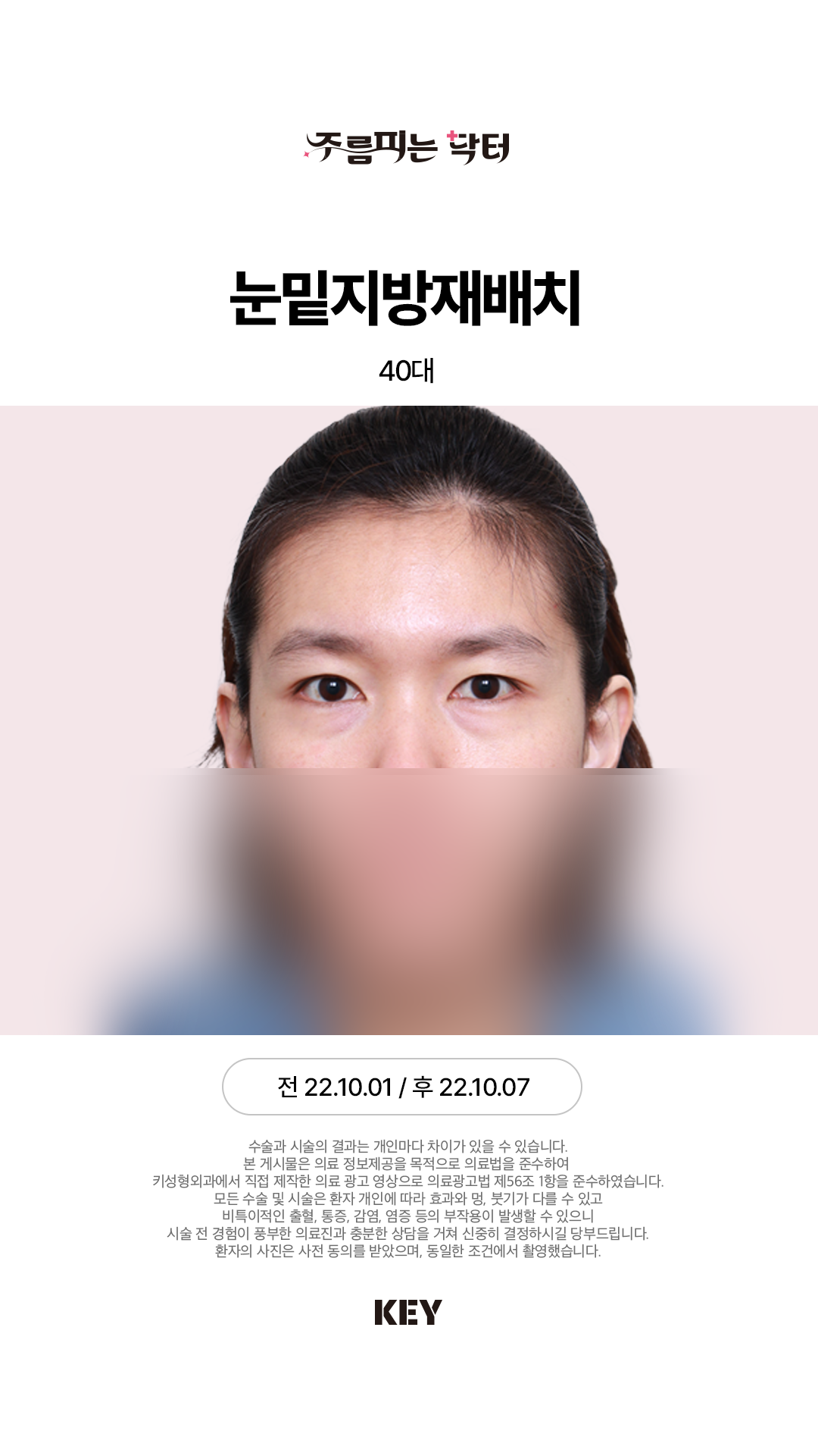 눈밑지방재배치 Before 3