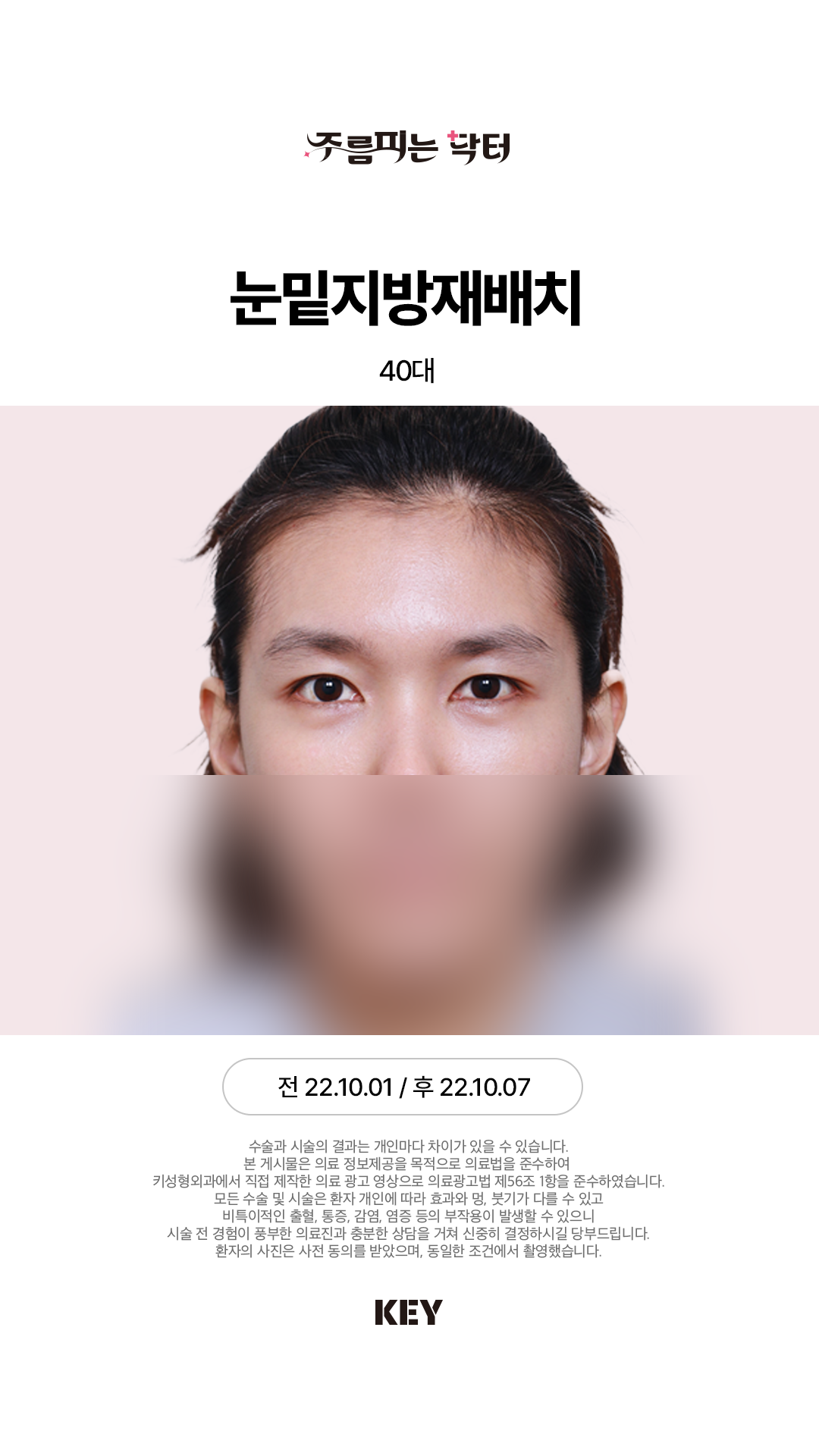 눈밑지방재배치 After 3