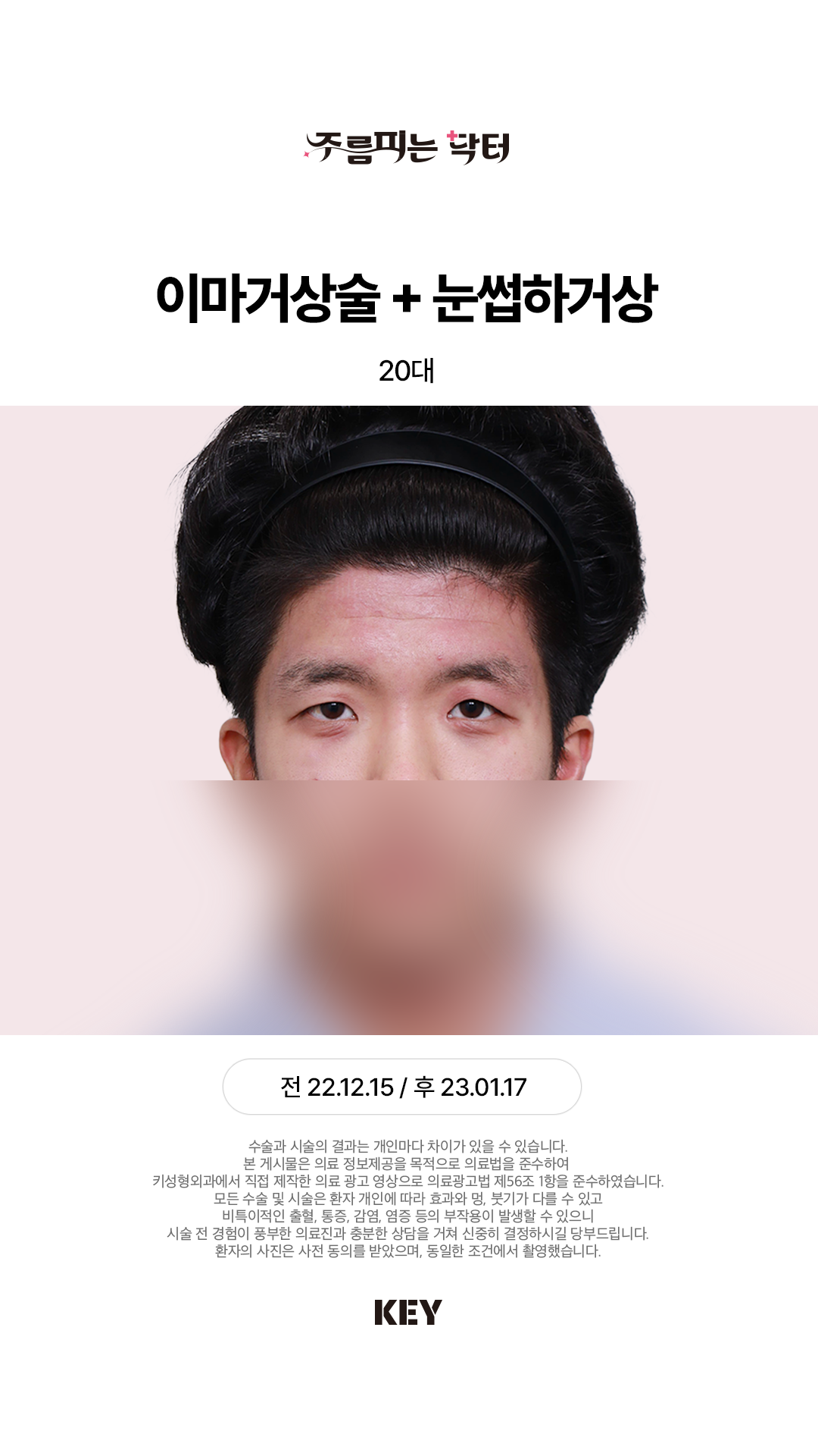 내시경 이마거상 Before 1