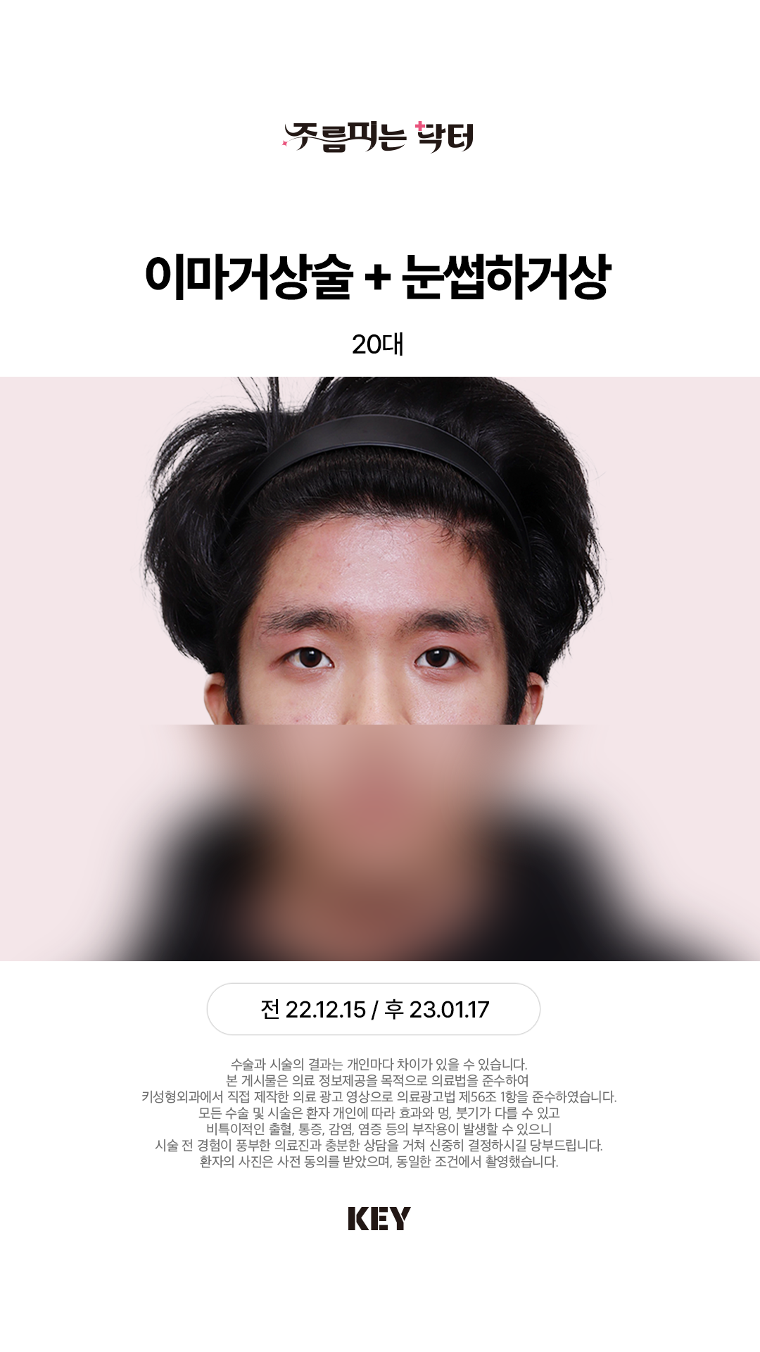 내시경 이마거상 After 1