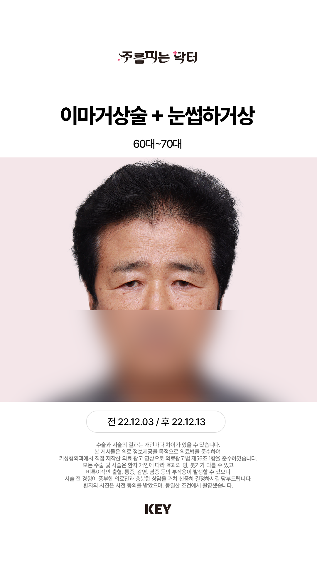 내시경 이마거상 Before 2