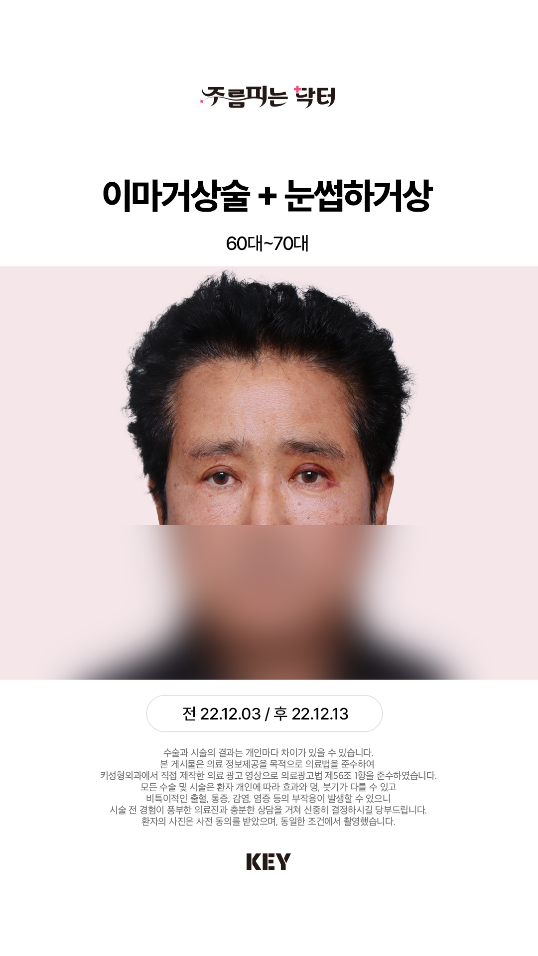 내시경 이마거상 After 2