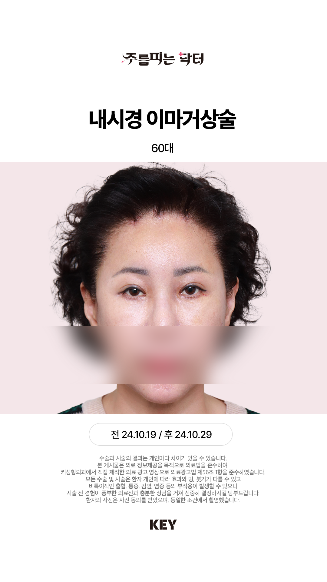 내시경 이마거상 After 3