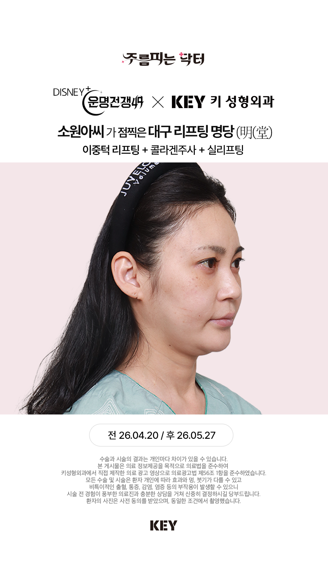 이중턱 리프팅 Before 1