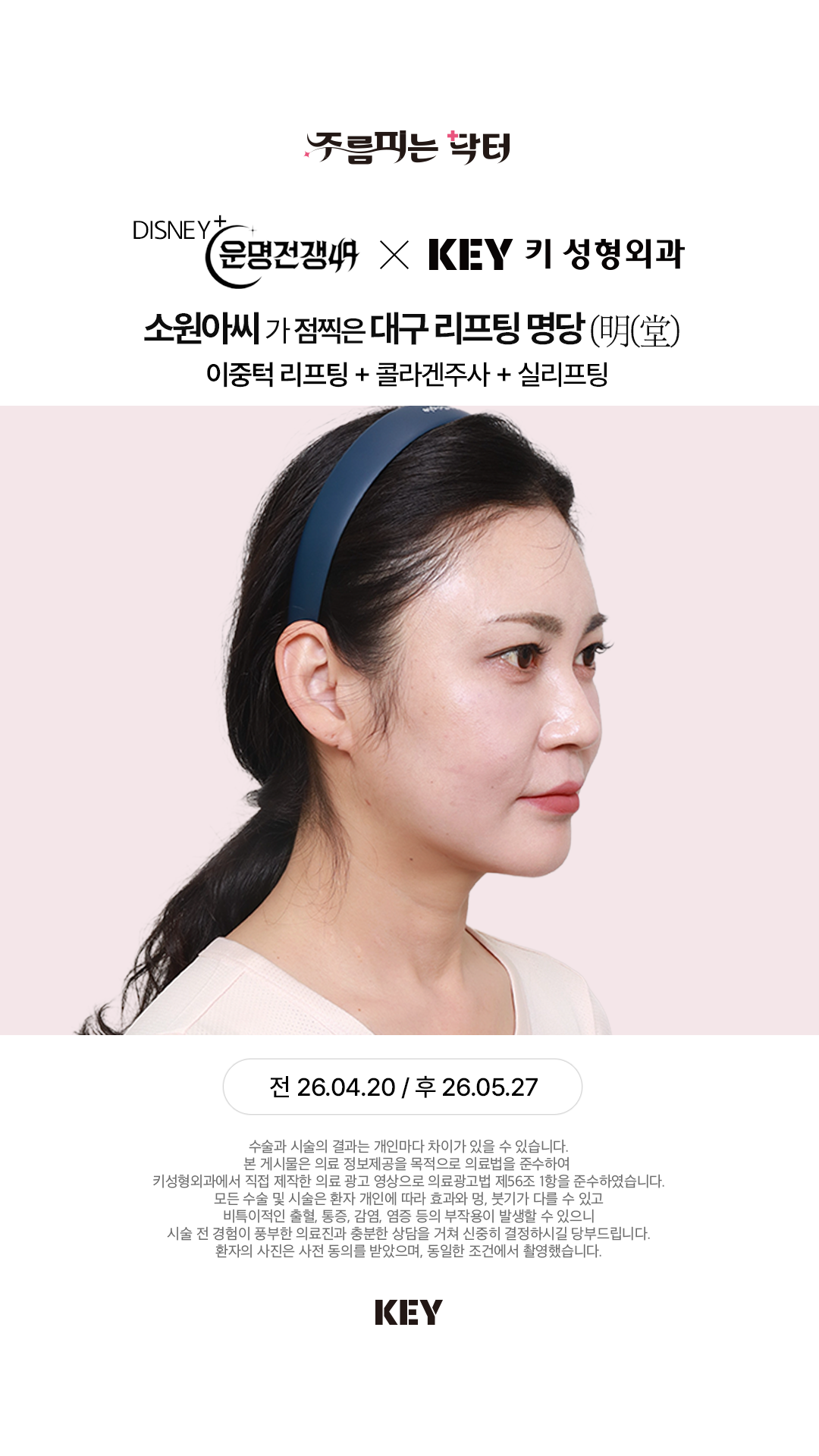 이중턱 리프팅 After 1