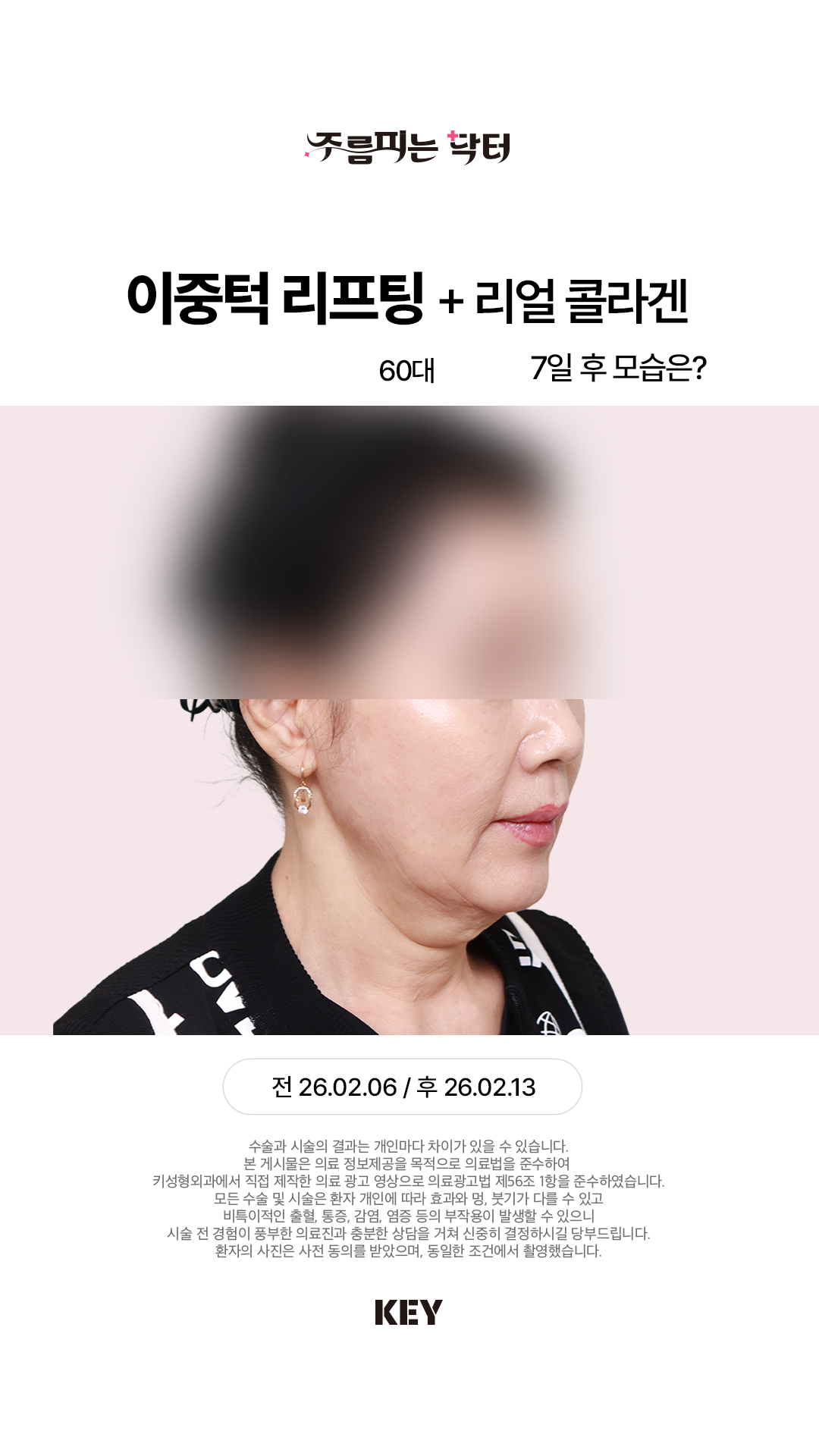 이중턱 리프팅 Before 3
