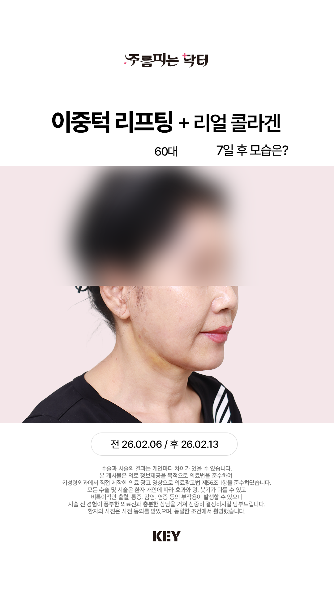 이중턱 리프팅 After 3