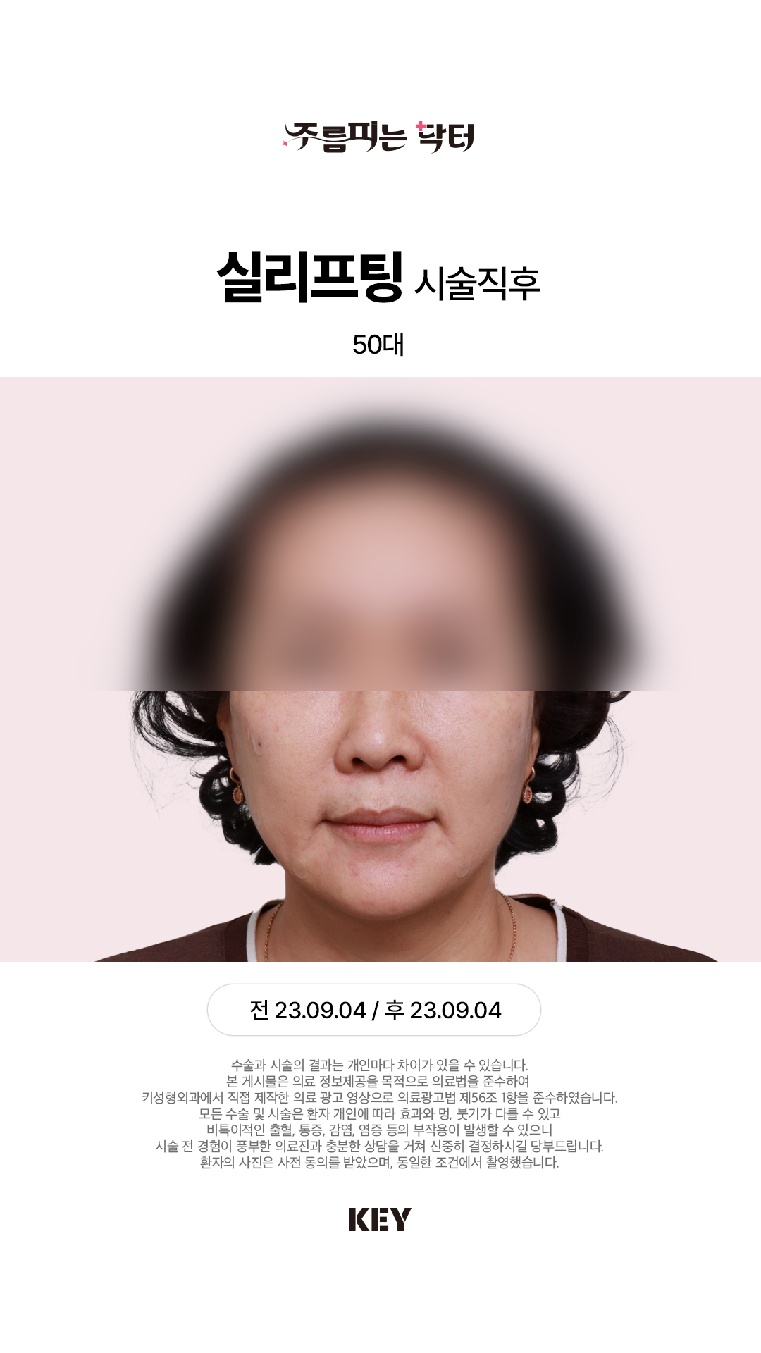 실리프팅 After 2