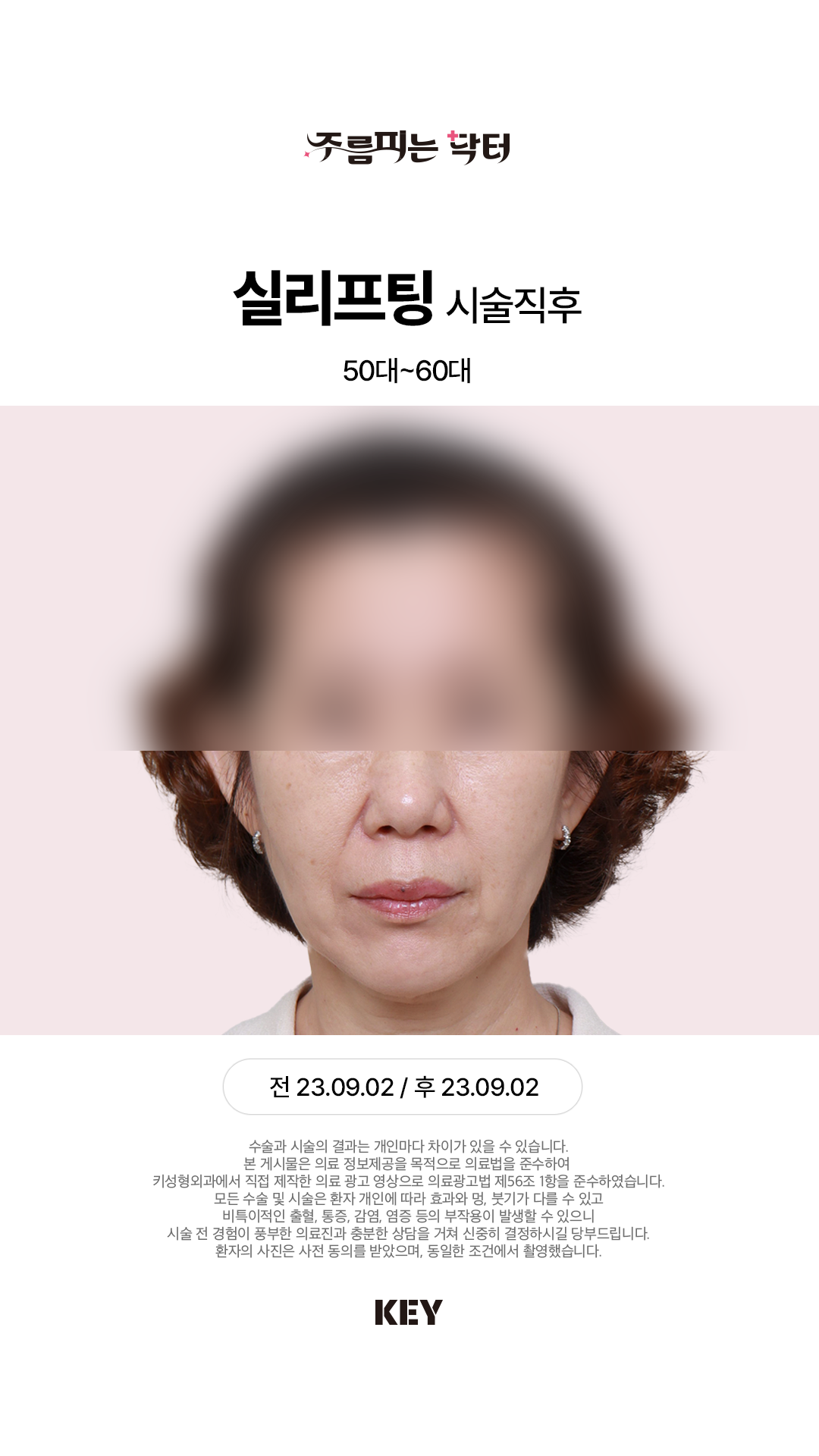 실리프팅 Before 3