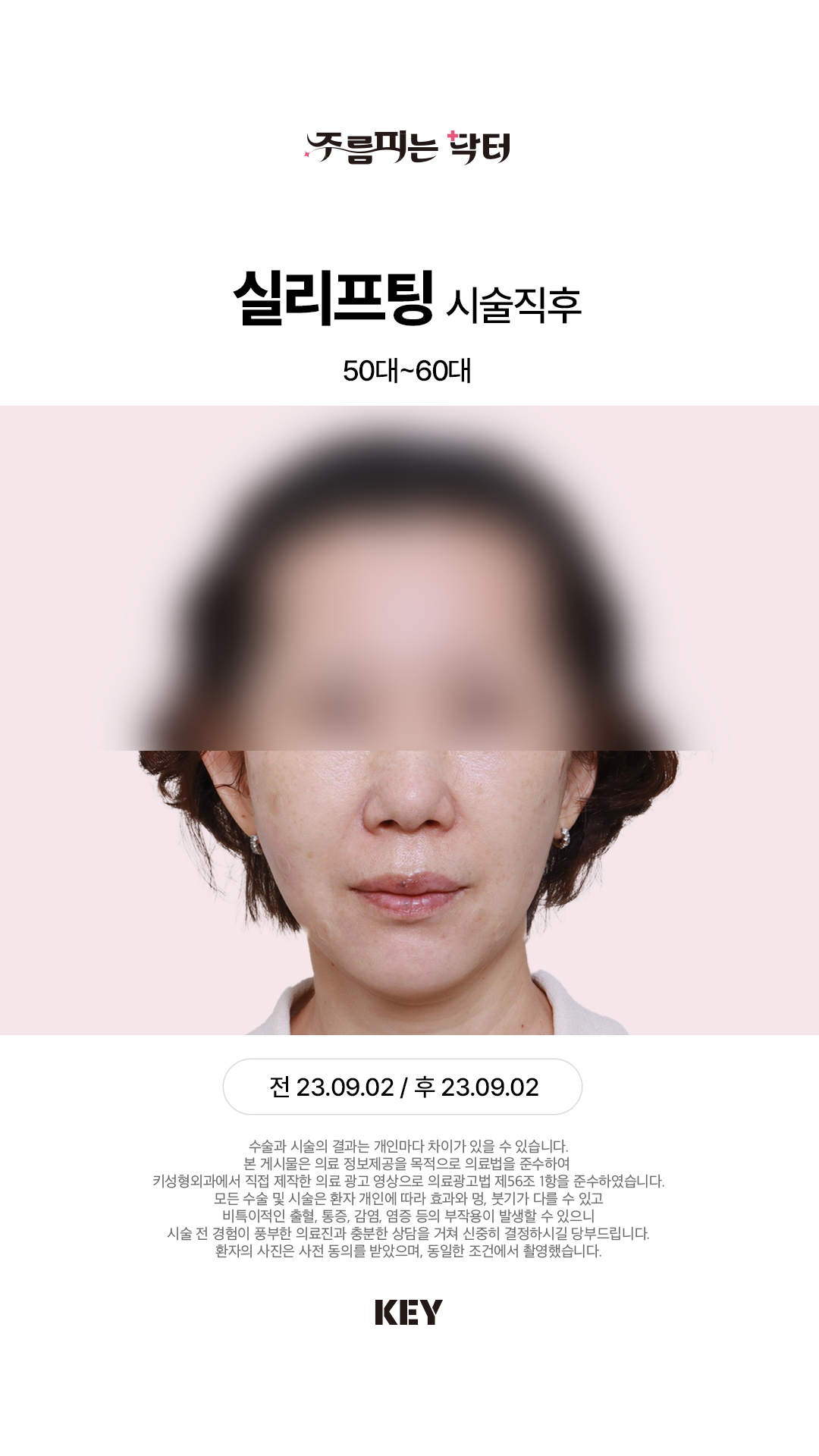 실리프팅 After 3