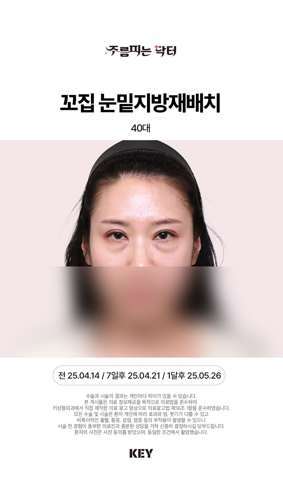꼬집 눈밑지방재배치 Before 1