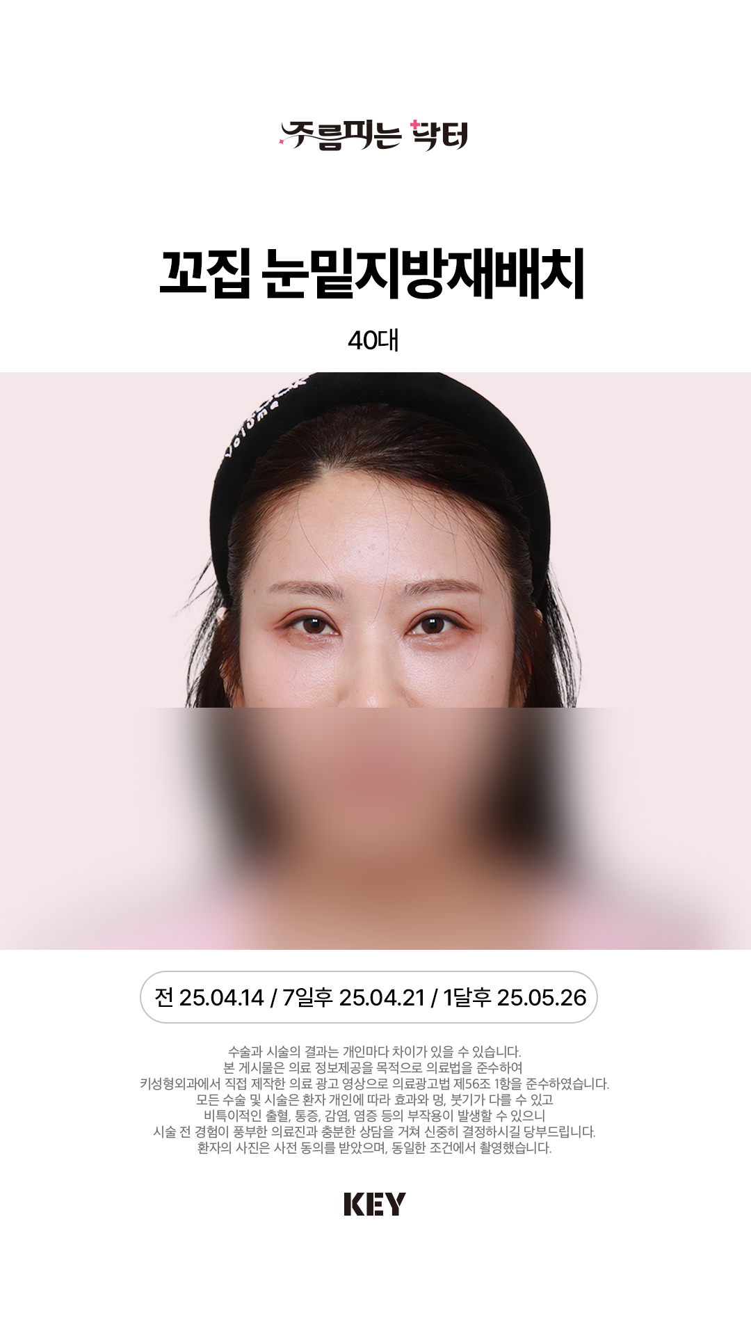 꼬집 눈밑지방재배치 After 1