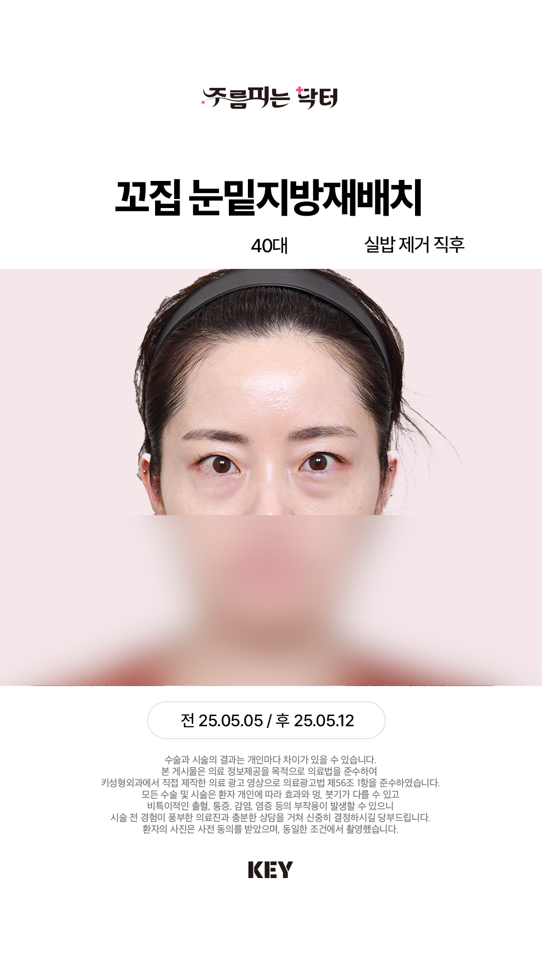 꼬집 눈밑지방재배치 Before 2