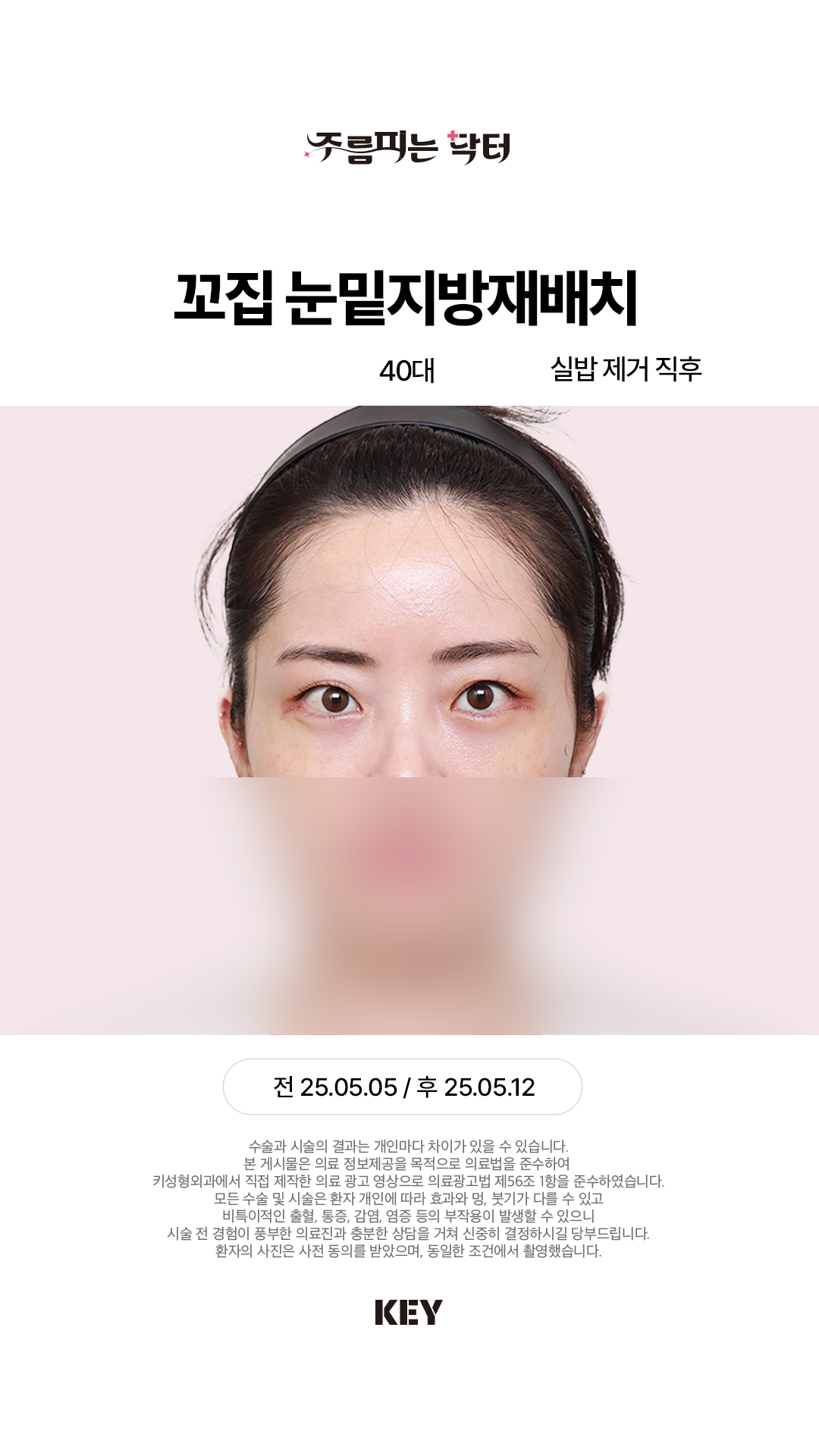 꼬집 눈밑지방재배치 After 2