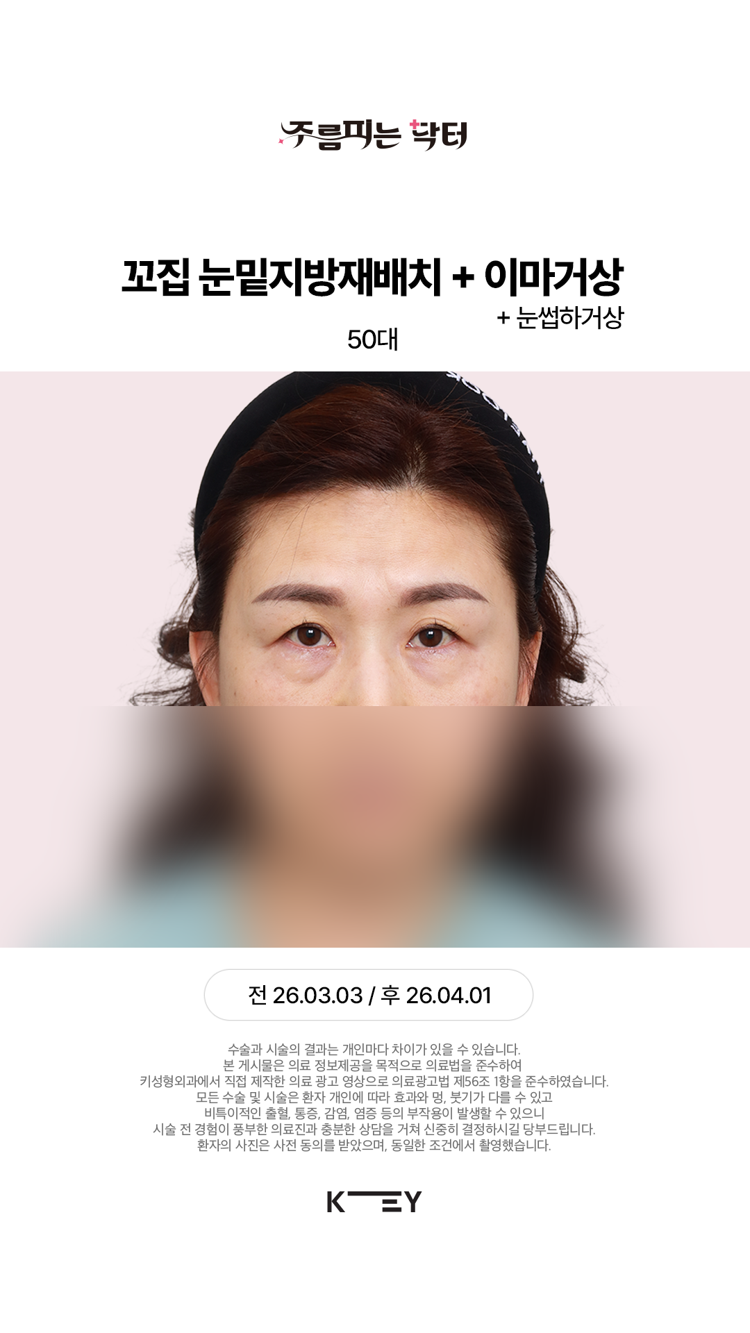 꼬집 눈밑지방재배치 Before 3