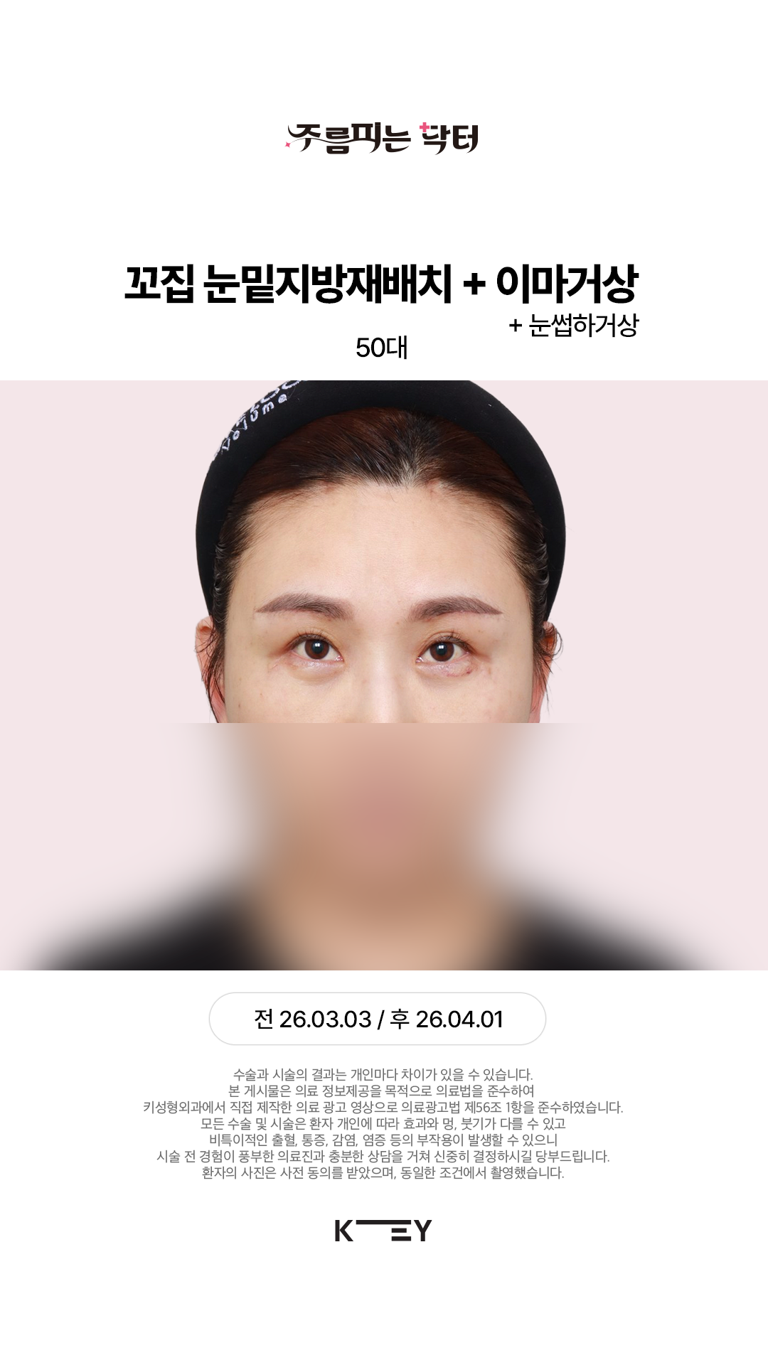 꼬집 눈밑지방재배치 After 3
