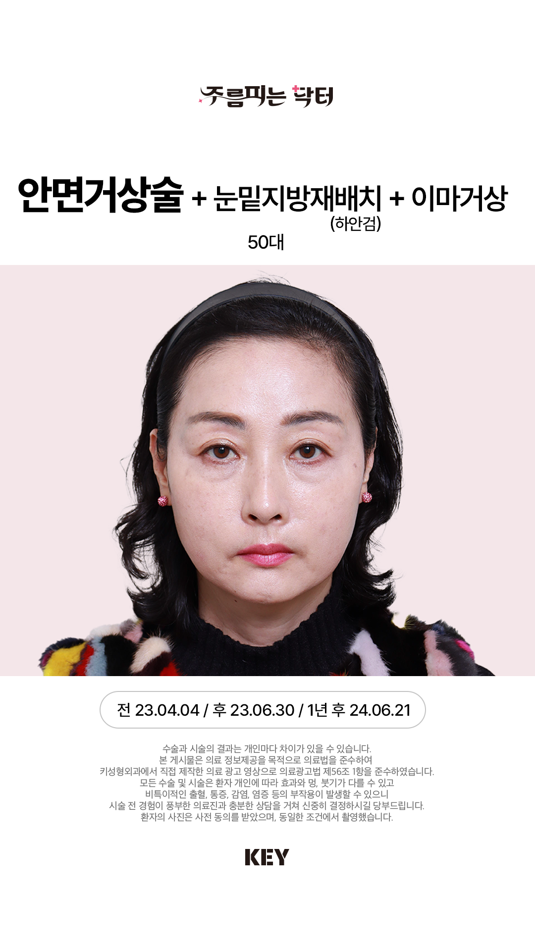 안면거상술 Before 1