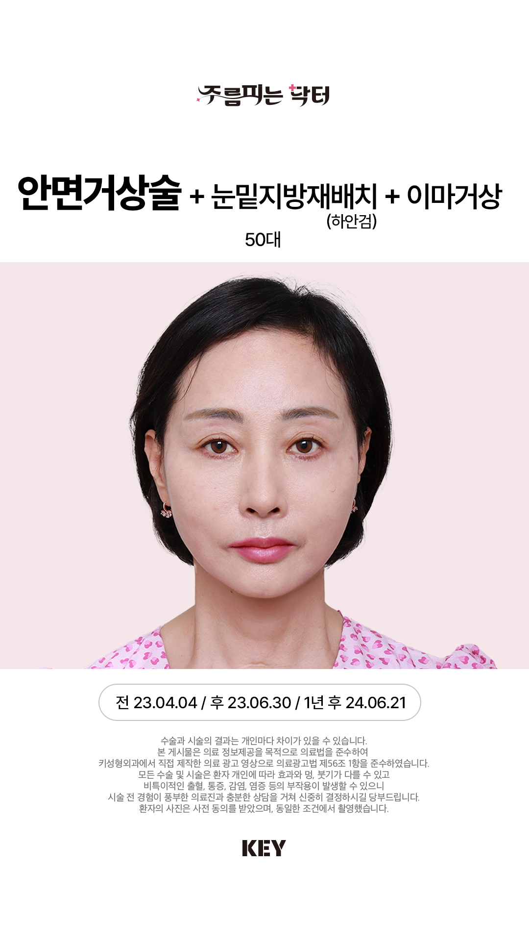 안면거상술 After 1