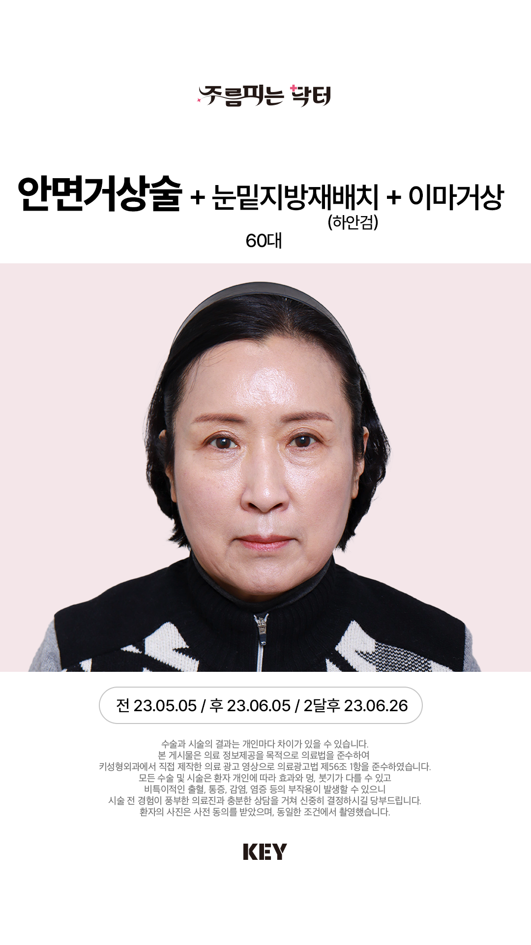 안면거상술 Before 2