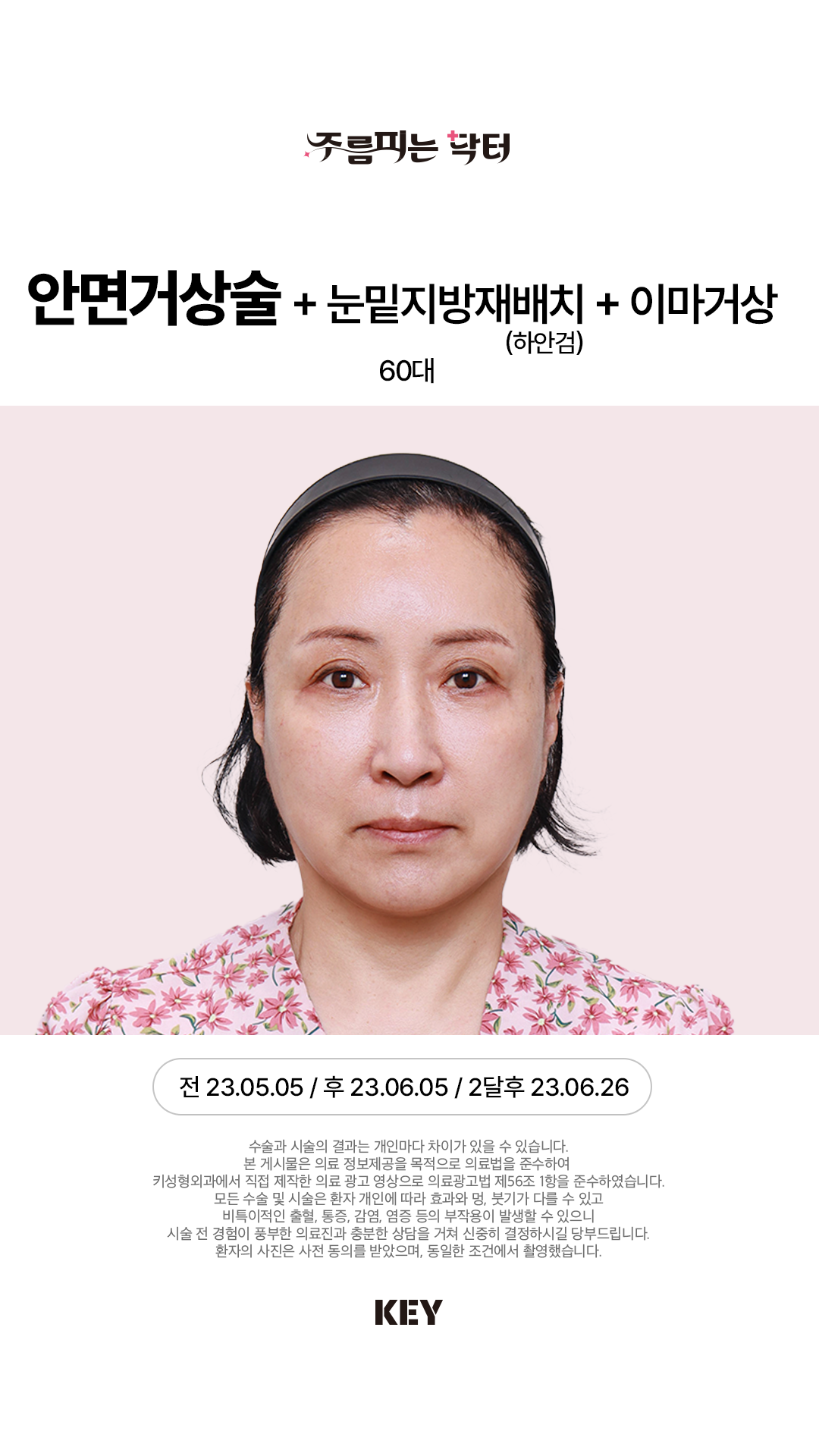 안면거상술 After 2