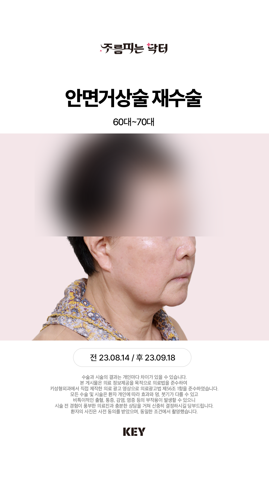안면거상술 Before 3