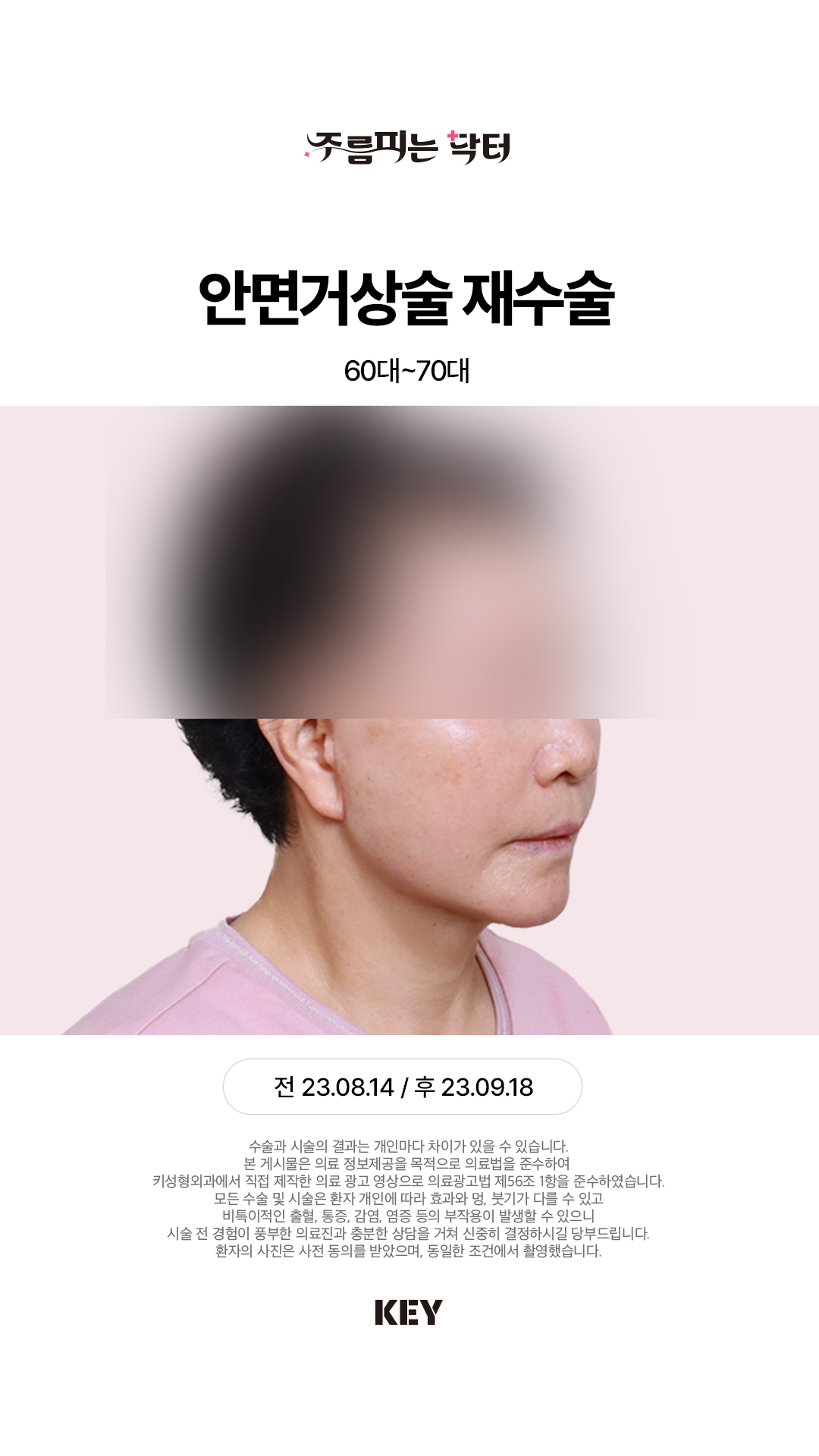 안면거상술 After 3